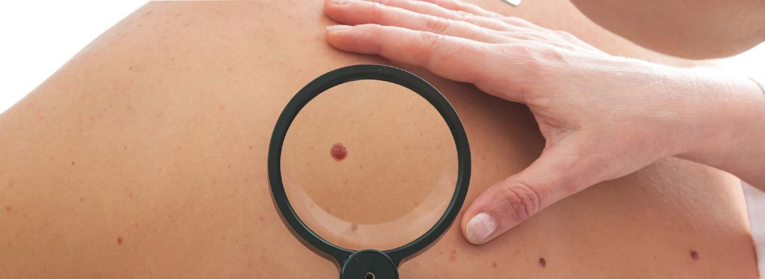 Comment protéger les taupes au soleil ?